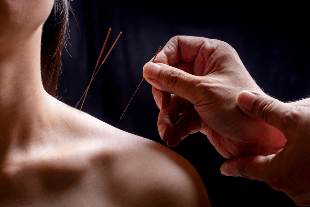 Neuro Acupuncture Treatment