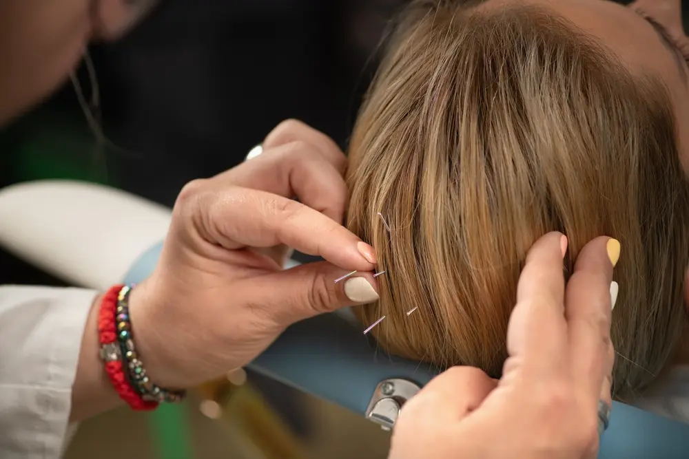 Neuro Acupuncture