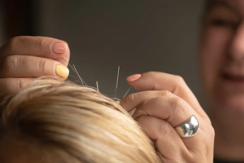 Zhu Scalp Acupuncture Treatment